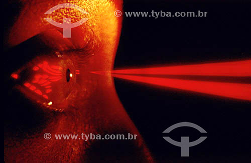  Cirurgia a laser nos olhos 