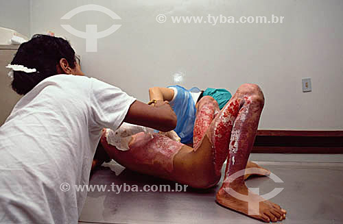   Hospital - Saúde - Medicina - Menor carente de rua sendo tratado de queimaduras por todo o corpo 