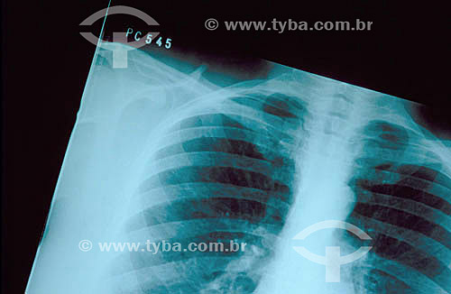  X-ray of the thorax  