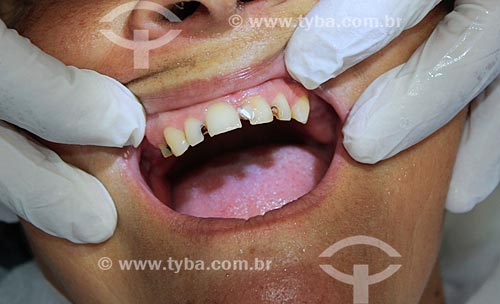  Dental care of the Doctors without borders Project - volunteer project in Northern region  - Porto Velho city - Rondonia state (RO) - Brazil