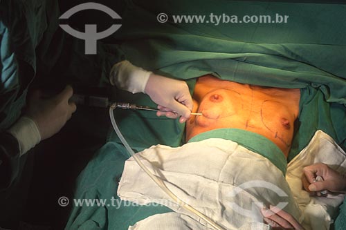  Breast reconstruction surgery - Mario Kroeff Hospital - 2000s  - Rio de Janeiro city - Rio de Janeiro state (RJ) - Brazil