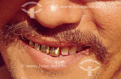  Detalhe de dentes de ouro - Garimpeiro 